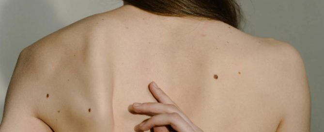 Hautkrebsvorsorge Duisburg