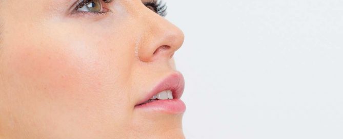 Nasolabialfalte Hyaluronsäure unterspritzen in Duisburg